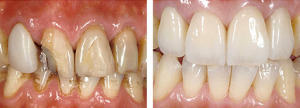 dental crowns before and after