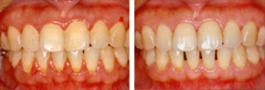 Scaling -dental cleaning before and after