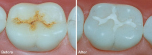 pit and fissure sealants before and after