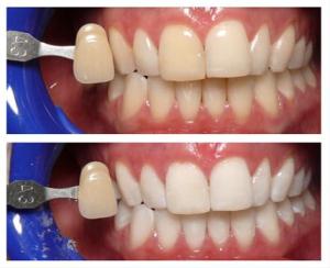 tooth whitening
