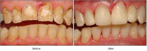 tooth colour fillings