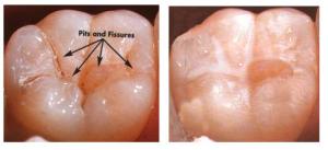 pit and fissure sealants before and after